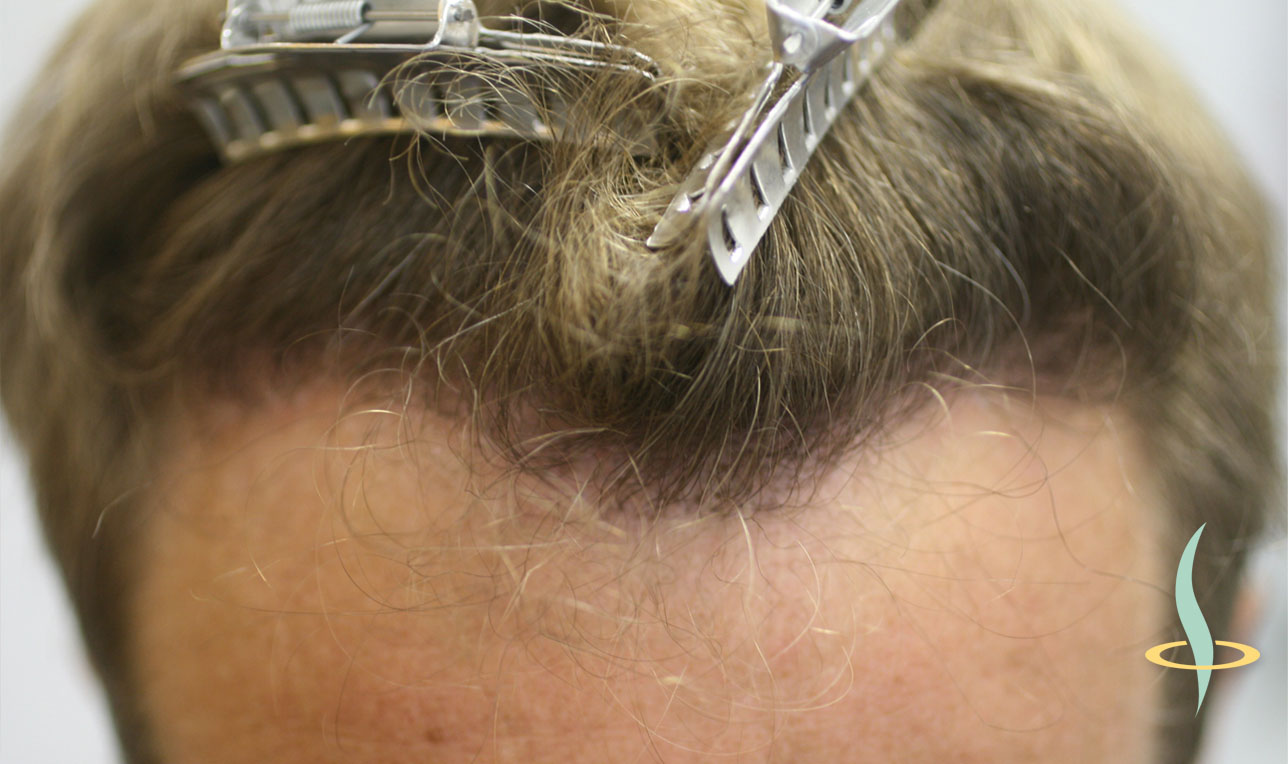 Illustration 11: Naissance des cheveux après la transplantation autologue.