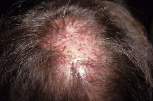 Irritations et cicatrices provenant d’une greffe de cheveux artificiels, visibles sur un cuir chevelu masculin