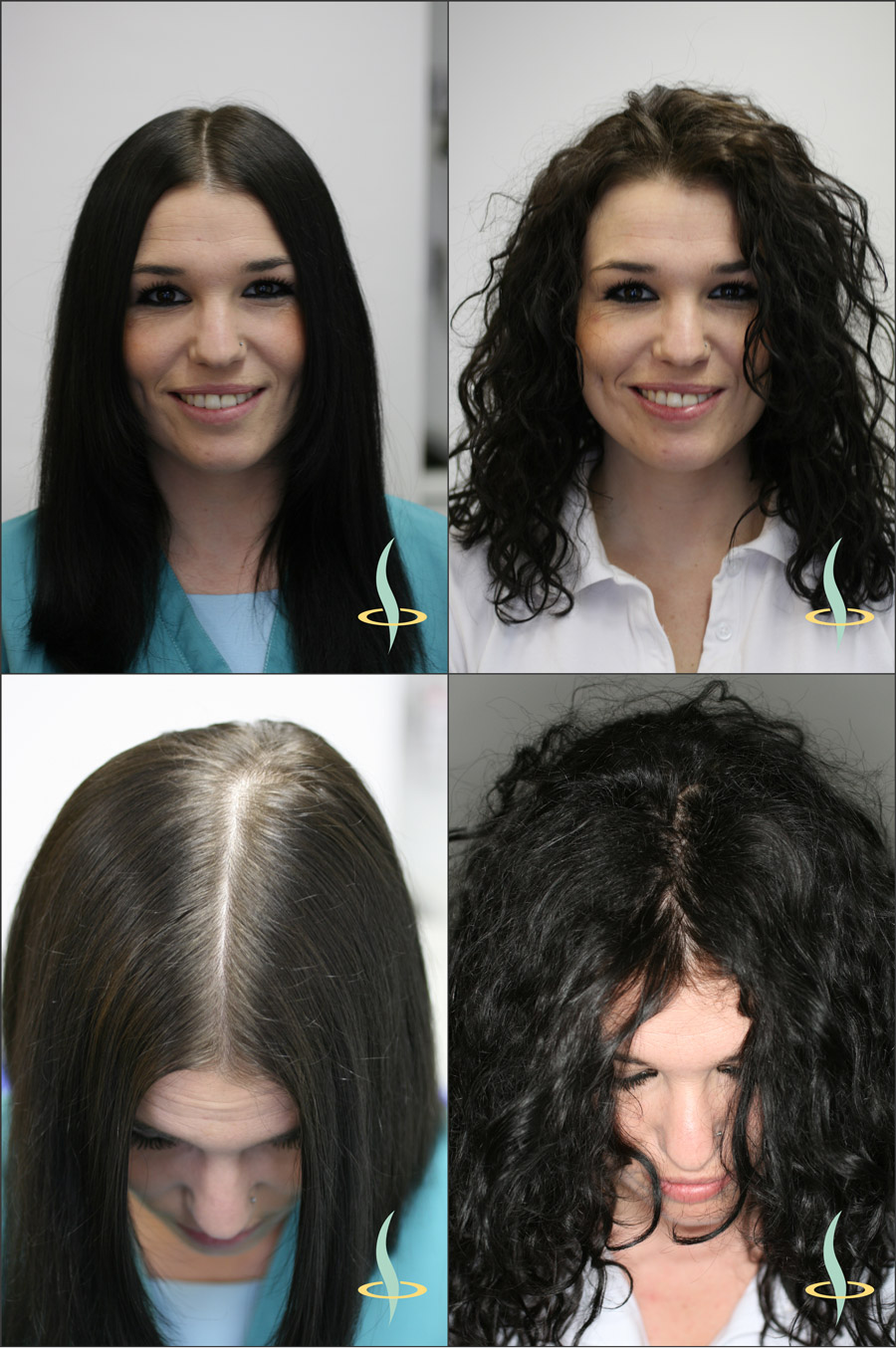 Illustration 2: Effet visuel des cheveux raides (à gauche) et bouclés (à droite) sur la visibilité du cuir chevelu. (Source: établi par l’auteur du document)